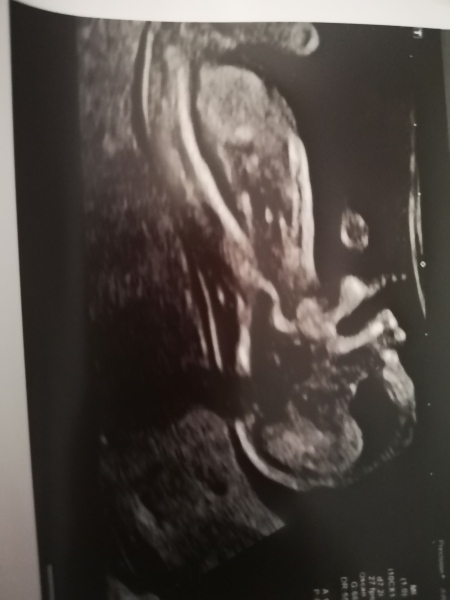 13 weeks - girl or boy