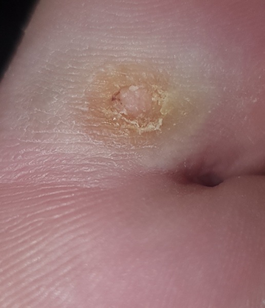 Is this a verruca still?? Picture attached