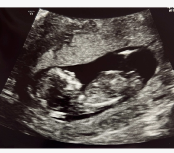 Nub theory? Boy or girl 🤍