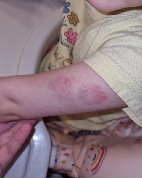 Toddler Bitten 6 Time Now at Nursery