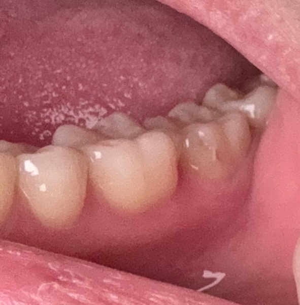 Teeth! Does this look like a cavity?
