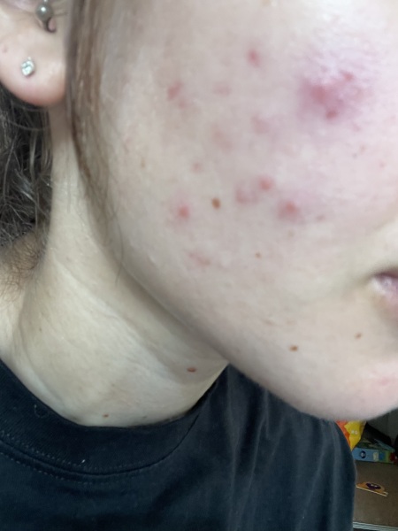 Skin purging??