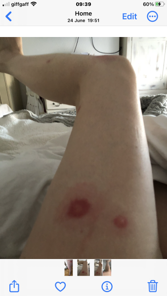 What is this bug that bit me?