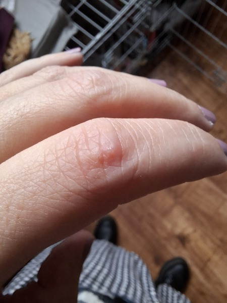 Hand infected (Warning, gross photos)