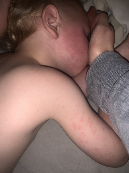Anyone have any idea what this rash could be?