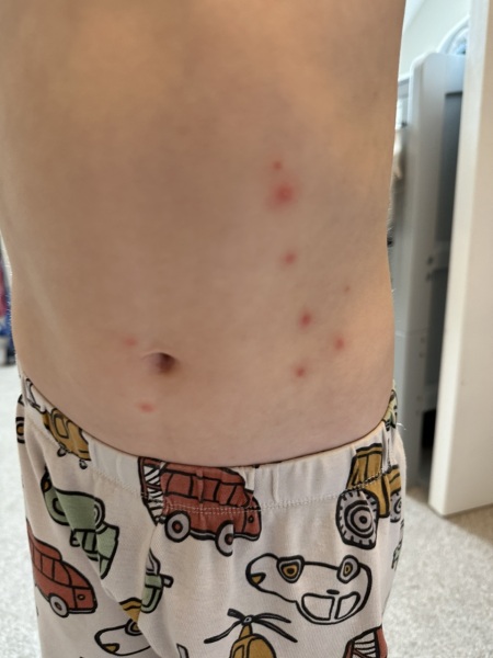 Red stops only on left side of 3 year olds abdomen
