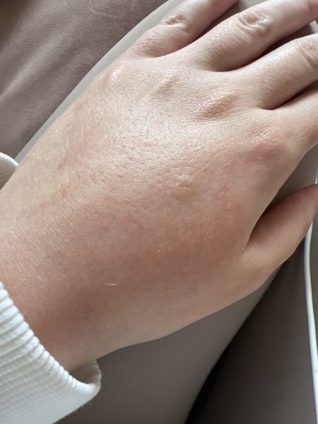 Wasp sting - swollen & painful again weeks later