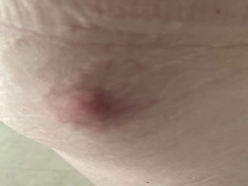 What is this on my hip?