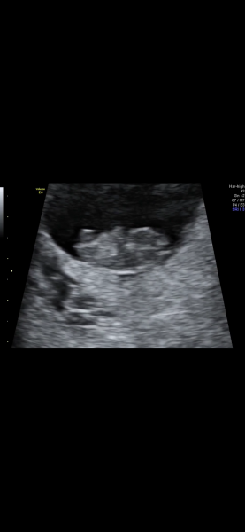 No symptoms/symptom loss in pregnancy