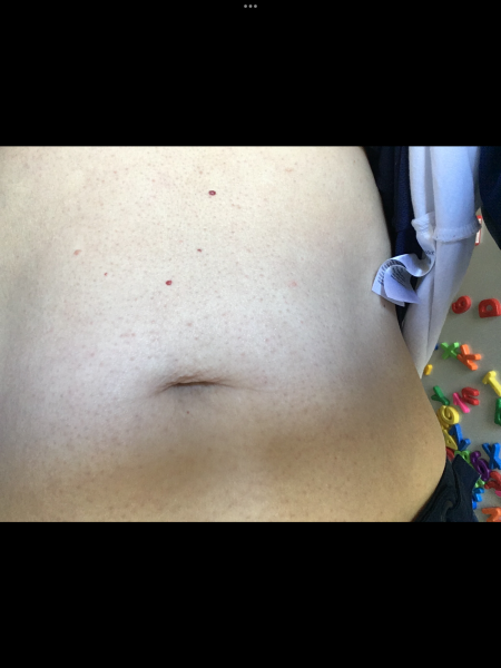 Could this rash be a reaction to antibiotics?
