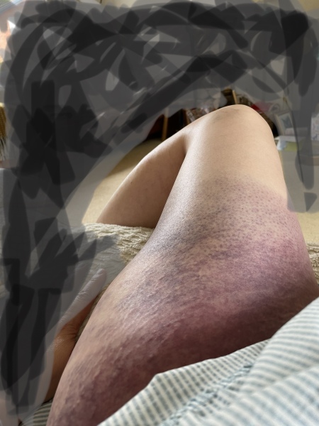 Recovery post road accident impact