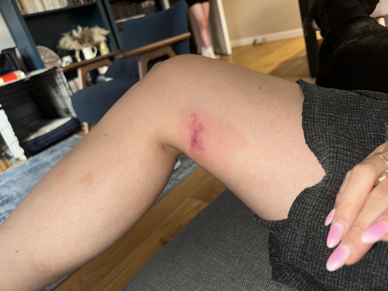 Mosquito bite — skeeter syndrome?