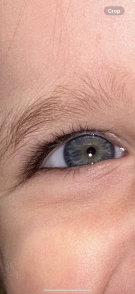 Grey whites of the eyes