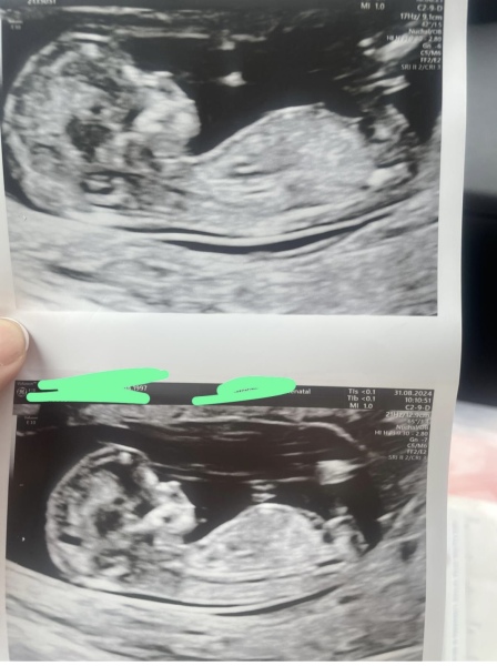 Possible Gender at 12 weeks 4 days