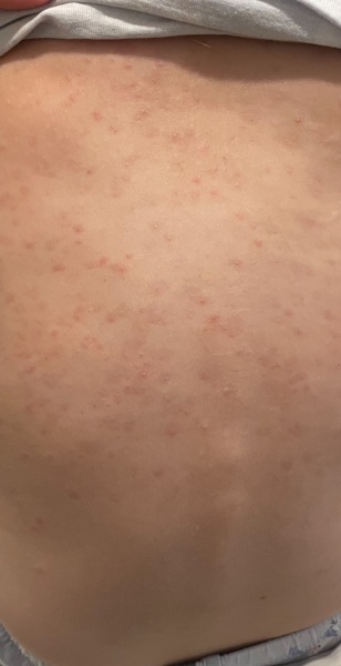 Eczema experiences?!