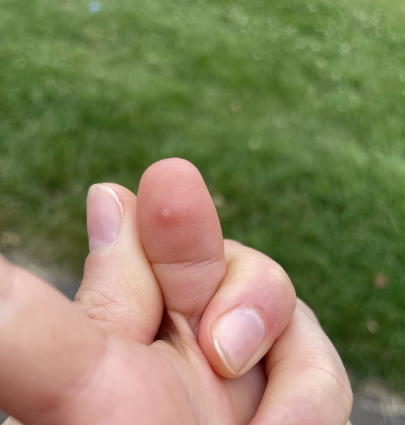 Bug bite ?