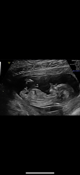 Gender at 14 weeks? Accurate?