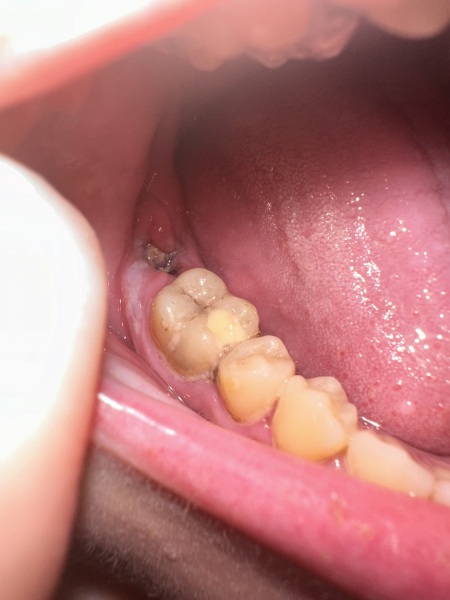 Excruciating tooth pain (gross photo)
