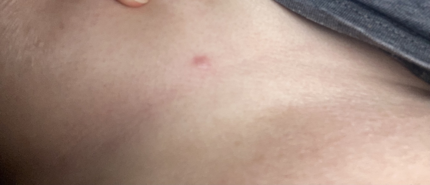 Lump under boob (picture)