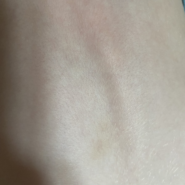 Am I right to be worried about these bruises?