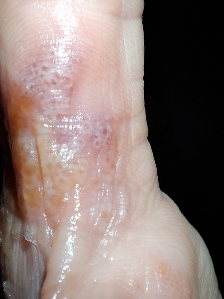 Hand infected (Warning, gross photos)