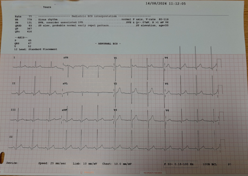 Abnormal ECG for complex needs child - anyone know how to interpret these?