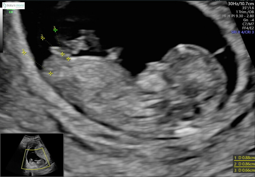 Nub 11 weeks 3 days