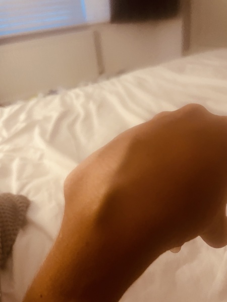 Weird vein after cannulation
