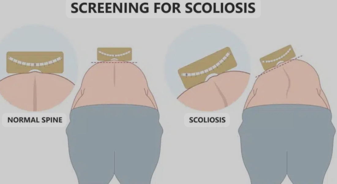 Bad posture or something more?