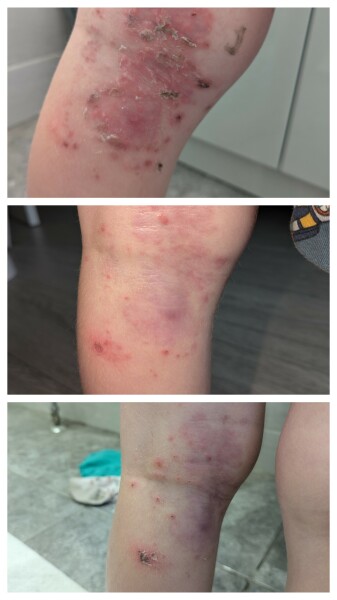 Infected bits getting worse?