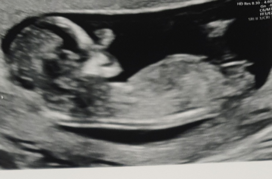 12 weeks scan predict gender