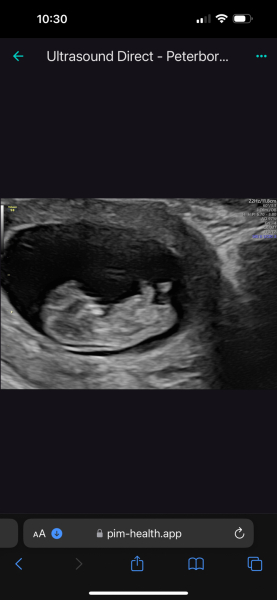 No symptoms/symptom loss in pregnancy