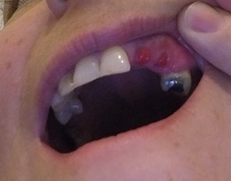 *Gross picture warning* site of tooth extraction