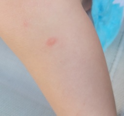 Please help identify these spots/bites