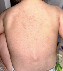 Has anyone else's 1 year old had severe rash after jabs?