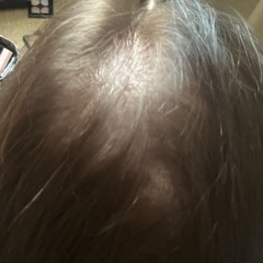 Post partum hairloss pics