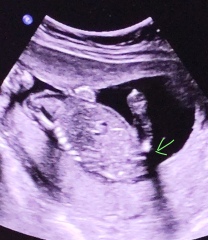 Nub theory: boy or girl?