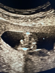 Potty shot @ 15 weeks, is it a boy???