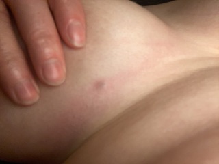 Lump under boob (picture)