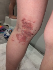 Infected bits getting worse?