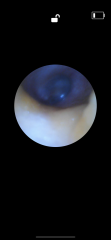 Any Drs or ear specialists on? Pic of eardrum