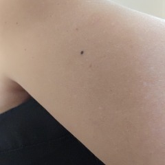 Worried about a black mole