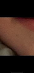Spider angioma ??