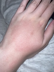 Wasp sting - swollen & painful again weeks later