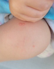 Please help identify these spots/bites