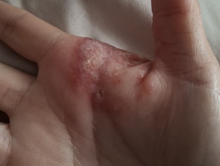 Hand infected (Warning, gross photos)