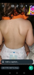 Toddler rash