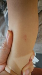 Spider bite? What are these marks?