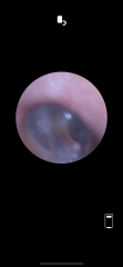 Any Drs or ear specialists on? Pic of eardrum