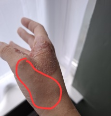 Hand infected (Warning, gross photos)